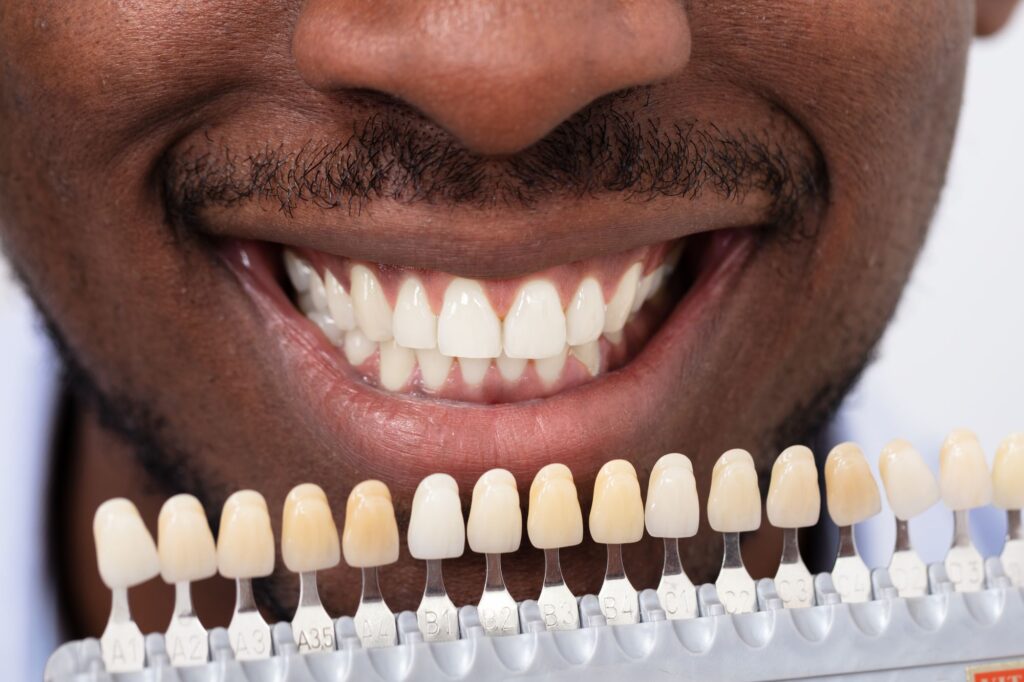 Teeth Whitening service
